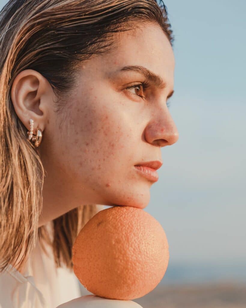 Teint terne et cicatrices d&rsquo;acné : Zoom sur la cure microneedling chez eliskin Bordeaux