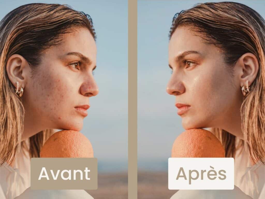 Avant apres microneedling