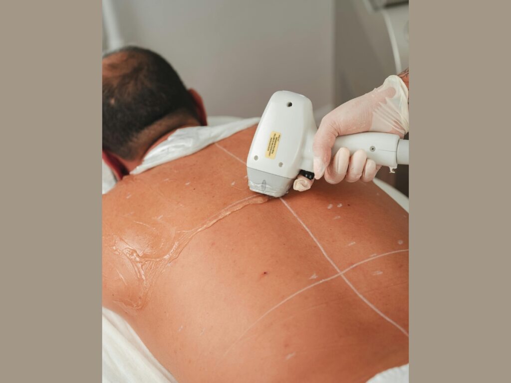 Traitement d'épilation laser du dos chez l'homme durant la saison froide pour éviter le bronzage et le soleil.